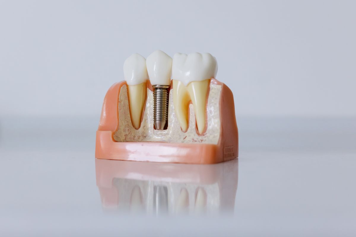 A cutaway dental model showing how an implant is anchored in the jaw beside natural teeth